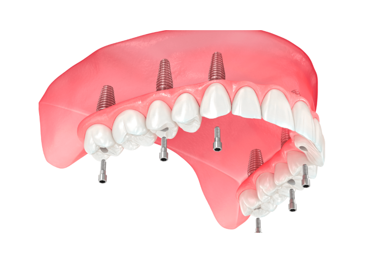 Ilustración tridimensional de una prótesis fija de maxilar superior apoyada en seis implantes, con sus tornillos de fijación.