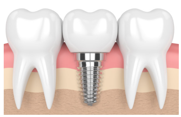 Ilustración de un implante dental unitario con corona, situado entre dos dientes naturales con sus raíces.