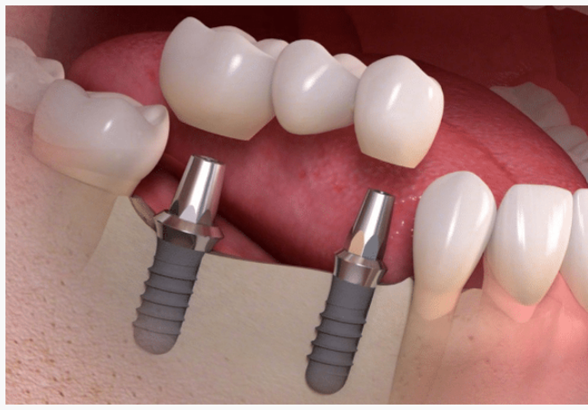 Ilustración de dos implantes dentales que sirven de apoyo a un puente fijo de tres coronas.