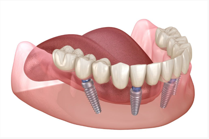 Ilustración tridimensional de una prótesis fija de mandíbula inferior apoyada en cuatro implantes de titanio.