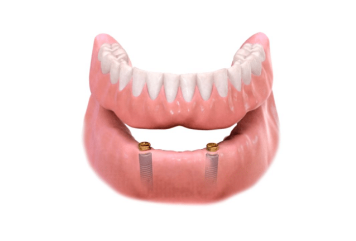 Ilustración tridimensional de una sobredentadura inferior removible apoyada sobre dos implantes con sus aditamentos de retención.